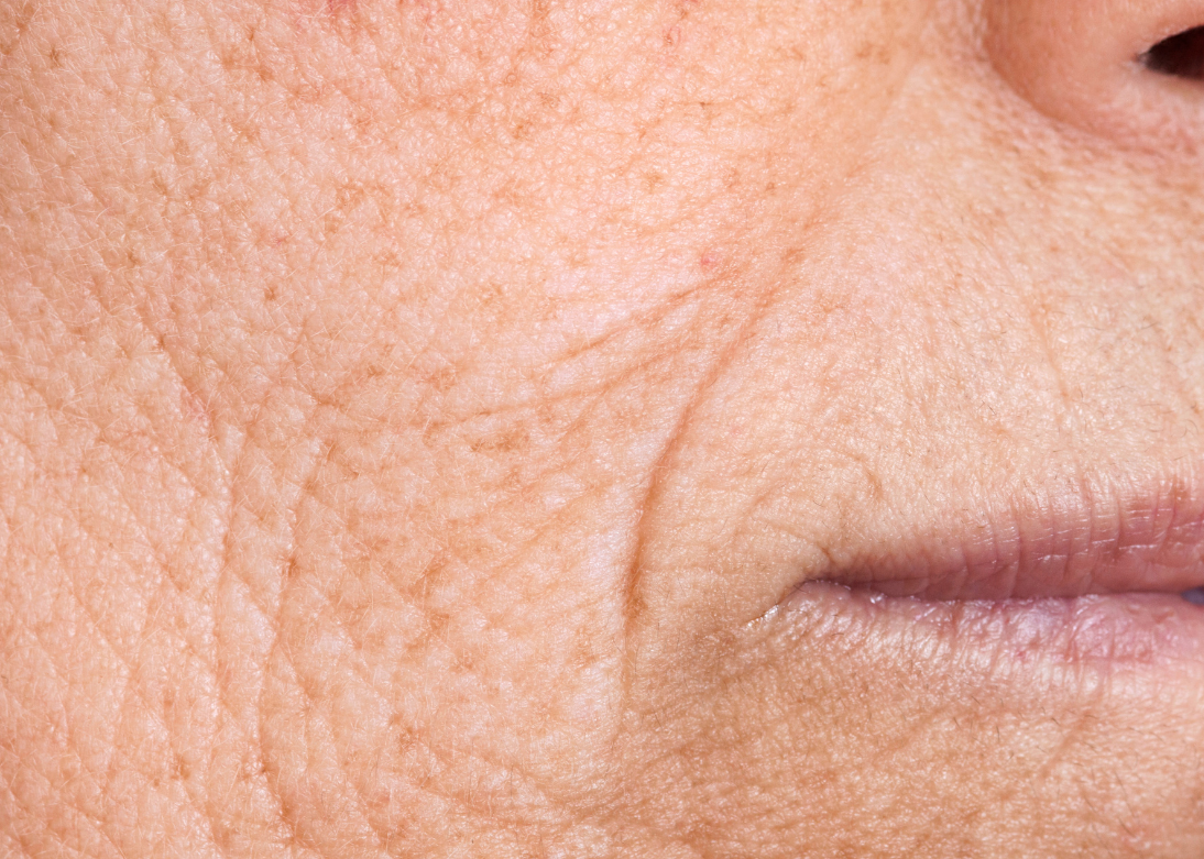 Wrinkles